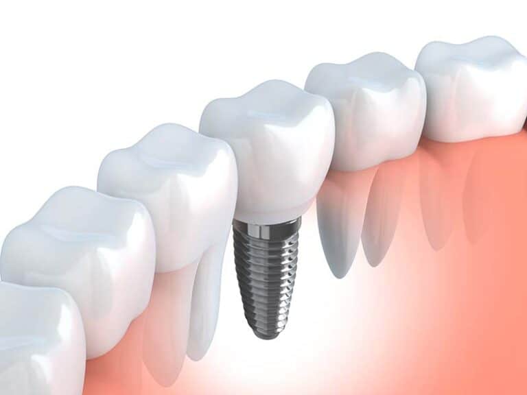 implantes dentales barcelona